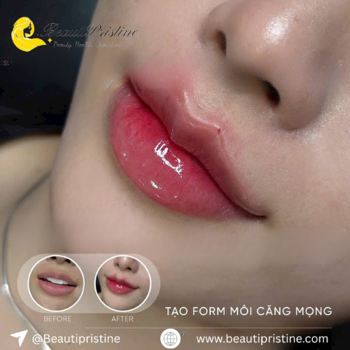 Tiêm Filler Môi Căng Mọng 