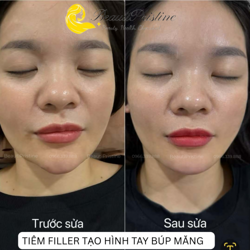 Tiêm Filler Chỉnh Sửa Cằm Lỗi 
