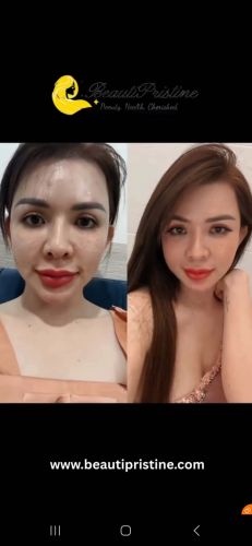 Cấy chỉ siết, nâng cơ, trẻ hóa da face và body 