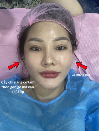 Siết cơ hạ gò má cao không phẩu thuật 