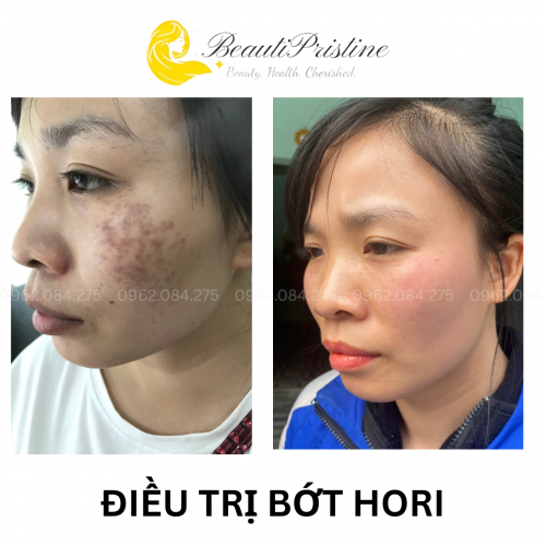 Laser Điều Trị Nám Chân Sâu 