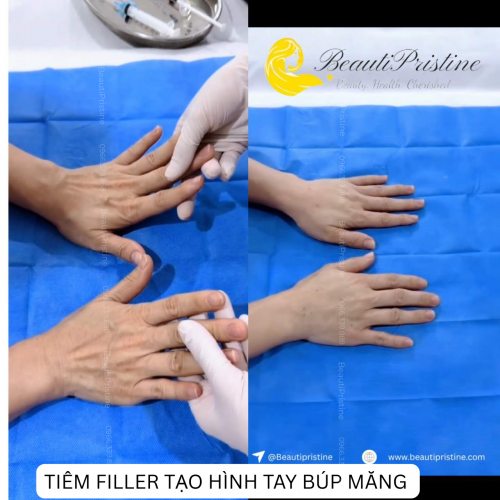 Tiêm Filler Tạo Hình Tay Búp Măng 