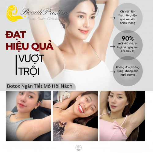 Tiêm Botox Ngăn Tiết Mồ Hôi Nách 