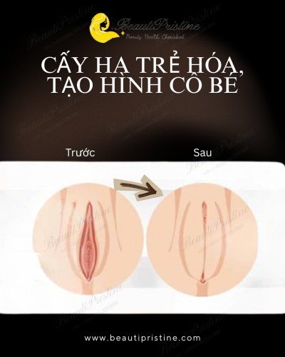 CẤY HA TẠO HÌNH CÔ BÉ 