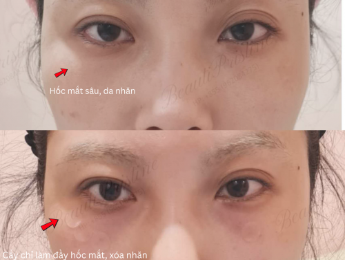 Cấy chỉ làm đầy hốc mắt, xóa nếp nhăn mắt 