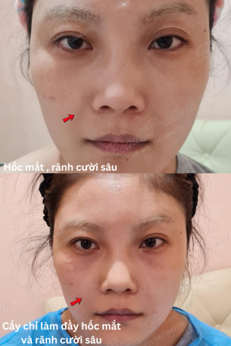 Cấy chỉ làm đầy rãnh cười, xóa nhăn da