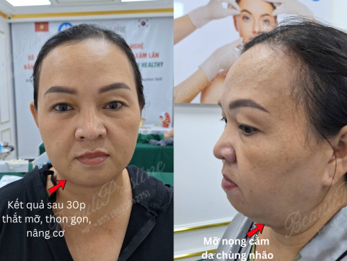 Cấy chỉ thắt mỡ nọng cằm, xóa tan nọng mỡ