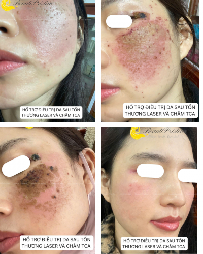 Phục Hồi Da Hư Tổn