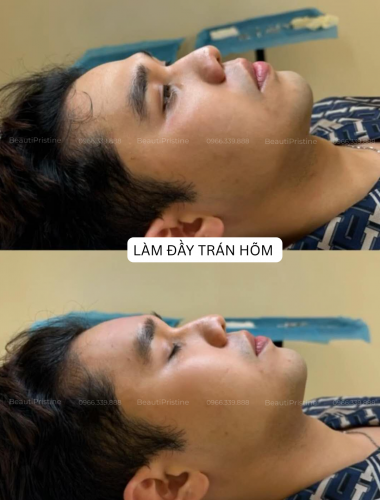 Tiêm Filler Làm Đầy Trán Hóp 