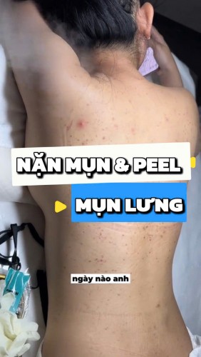 ĐIỀU TRỊ MỤN LƯNG