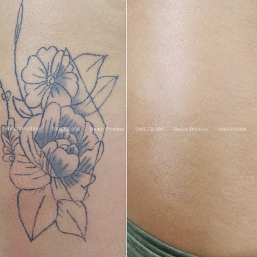 Laser Xóa Xăm Body 