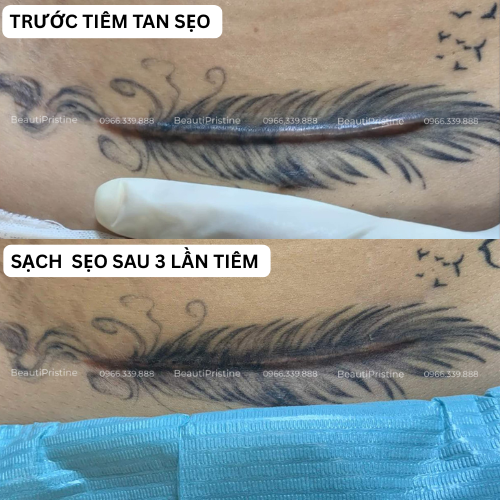 Tiêm Tan Sẹo Lồi 