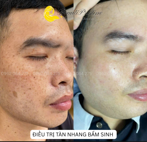 Laser Điều Trị Tàn Nhang 