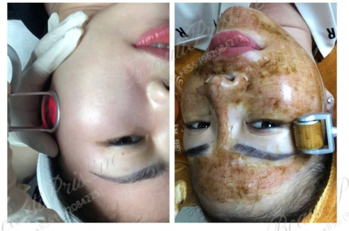 Lăn kim trẻ hóa và điều trị 