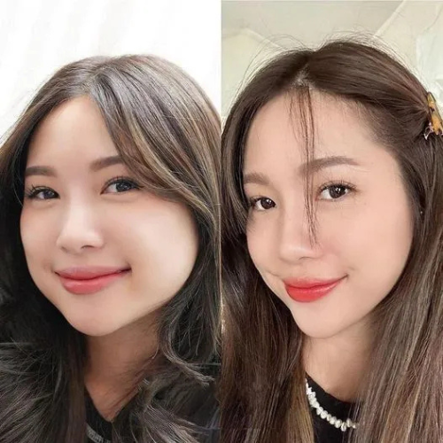 Tiêm Botox Thọn Gọn Hàm 