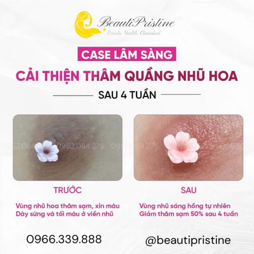 Dịch Vụ Làm Hồng Ti, Hồng Bikini