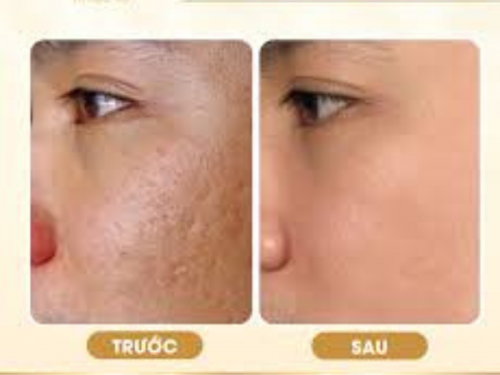 Phi kim trẻ hóa, điều trị da