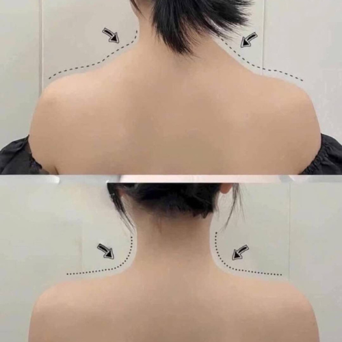 Tiêm Botox Hạ Cầu Vai 