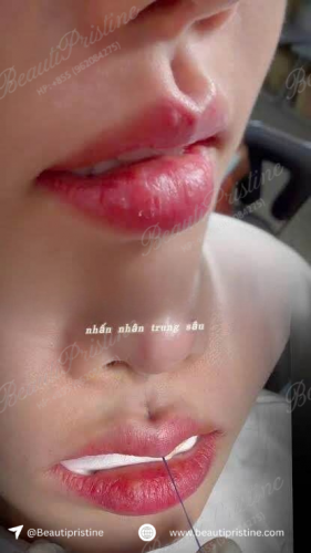 Nhấn Nhân Trung Bằng Chỉ 