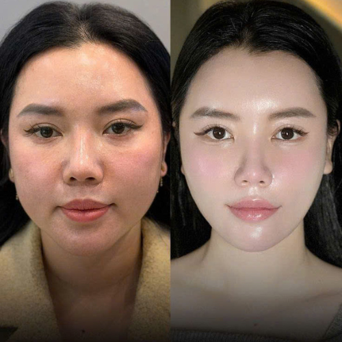 Rf Căng Bong Da, Thu Nhỏ Lổ Chân Lông To 