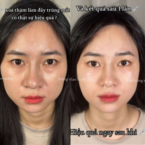 Tiêm Tăng Sinh Làm Đầy Trũng Sâu, Xóa Thâm Mắt 