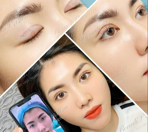 Nhấn Mí Bằng Chỉ 