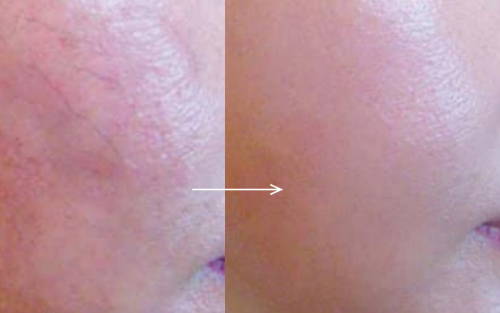 Laser Điều Trị Mao Mạch