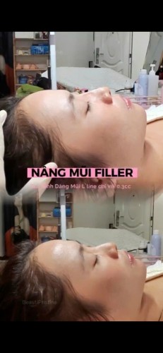 TIÊM FILLER NÂNG MŨI