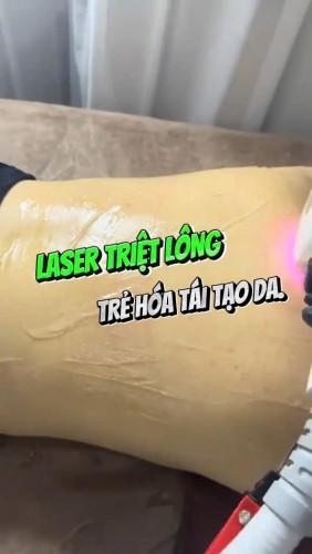 TRIỆT LÔNG LƯNG DIODE LASER & HÀN BĂNG LẠNH