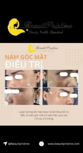 ĐIỀU TRỊ NẠM GÓC MẮT
