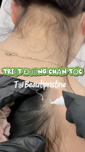 TRIỆT LÔNG TẠO ĐƯỜNG CHÂN TÓC 
