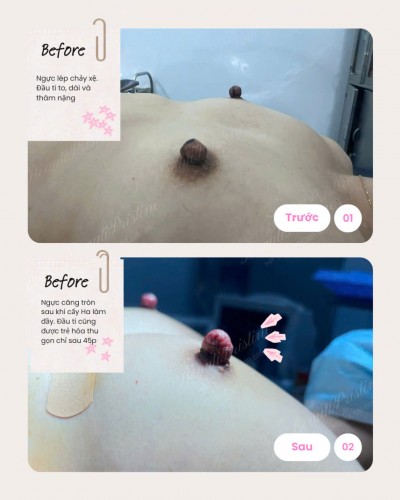 TRẺ HÓA, TẠO HÌNH VÀ THU NHỎ ĐẦU TI 