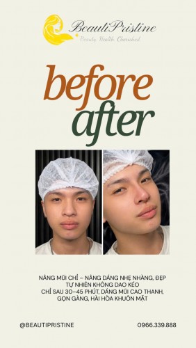 NÂNG MŨI CHỈ HÀN QUỐC 