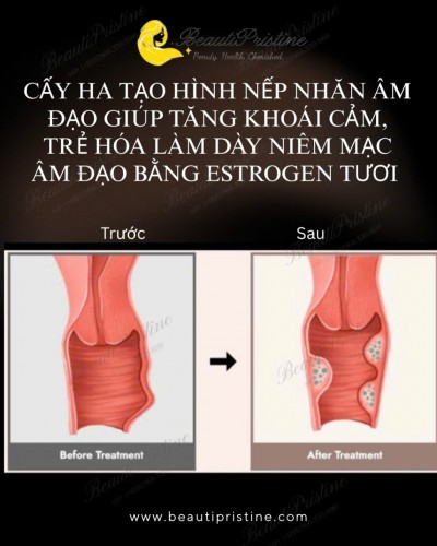 TẠO NẾP NHĂN VÀ LÀM DÀY NIÊM MẠC ÂM ĐẠO