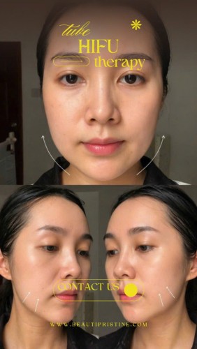 HIFU LIFTING, GIẢM MỠ 