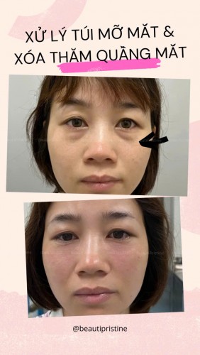 TIÊM XÓA TAN BỌNG MẮT 
