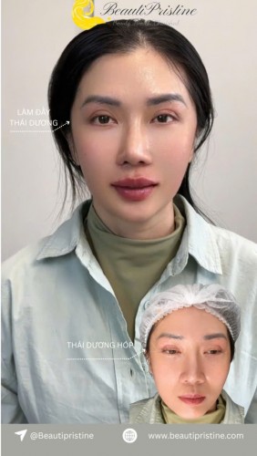 TIÊM FILLER LÀM ĐẦY THÁI DƯƠNG