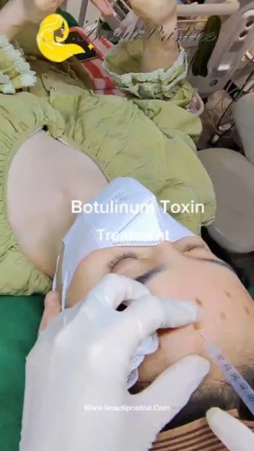 TIÊM BOTOX XÓA NHĂN TRÁN 