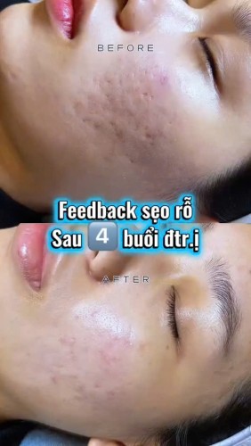 ĐIỀU TRỊ SẸO RỖ 