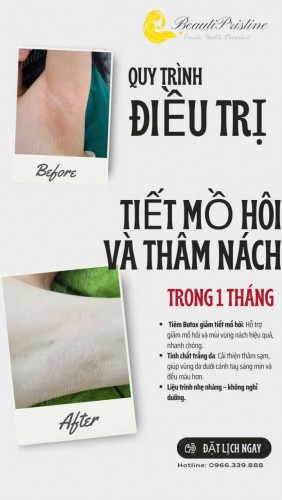 ĐIỀU TRỊ TIẾT MỒ HÔI VÀ LÀM TRẮNG DA VÙNG NÁCH
